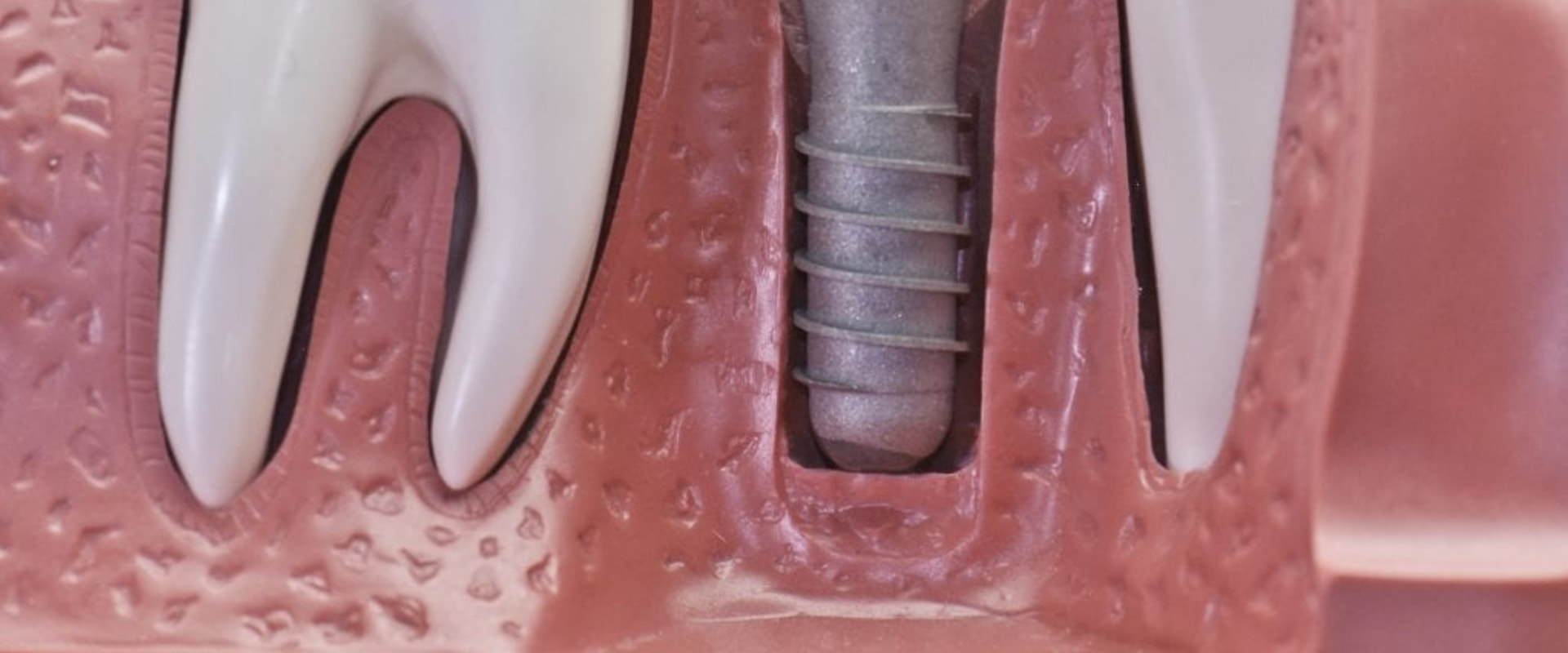 Can the dental implant cause a headache