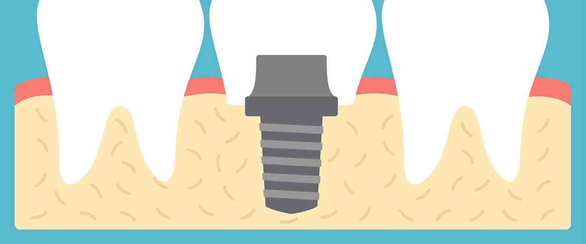 Do dental implants have serial numbers?