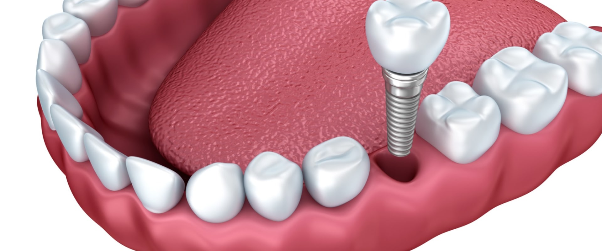 Are dental implants rejected?
