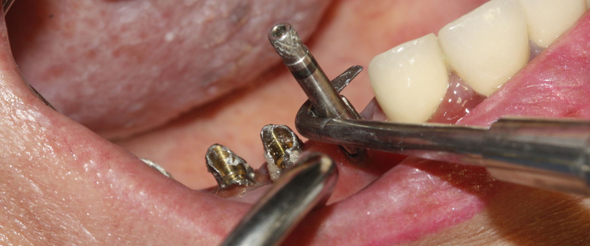 Can the screws be removed from dental implants?