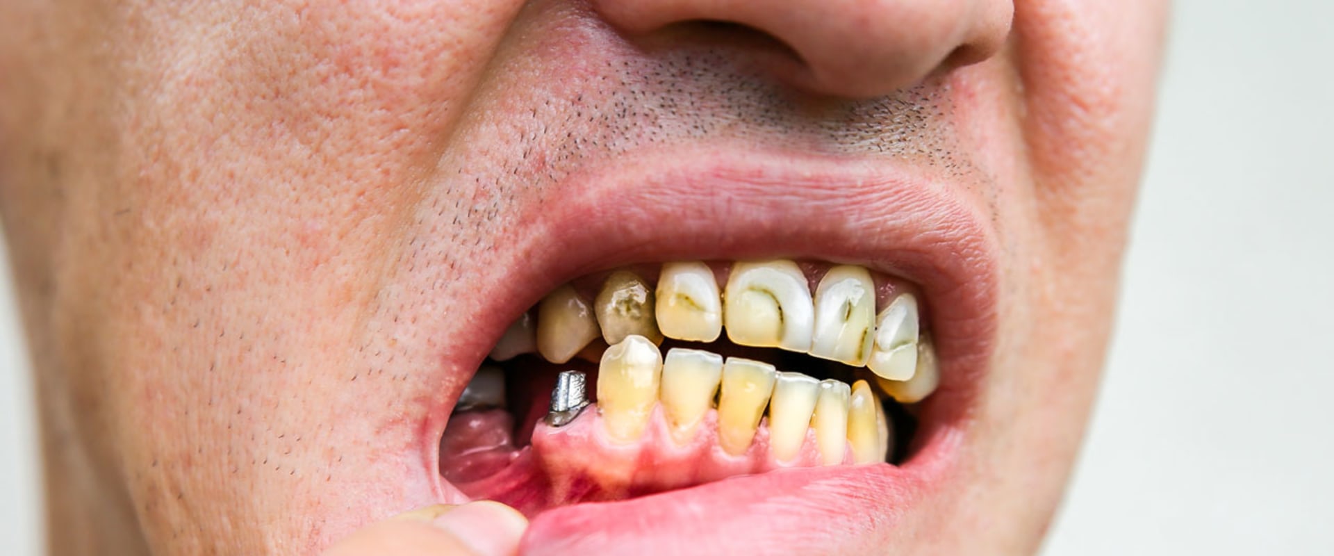 Is it normal for an implant to hurt?