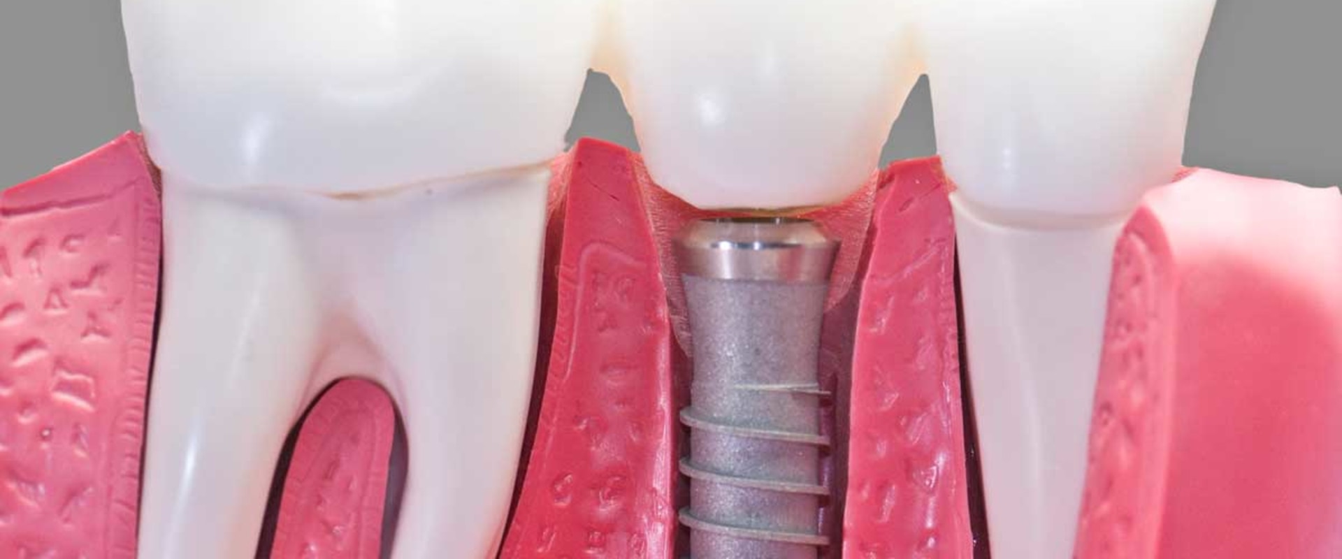 How common is the rejection of dental implants?