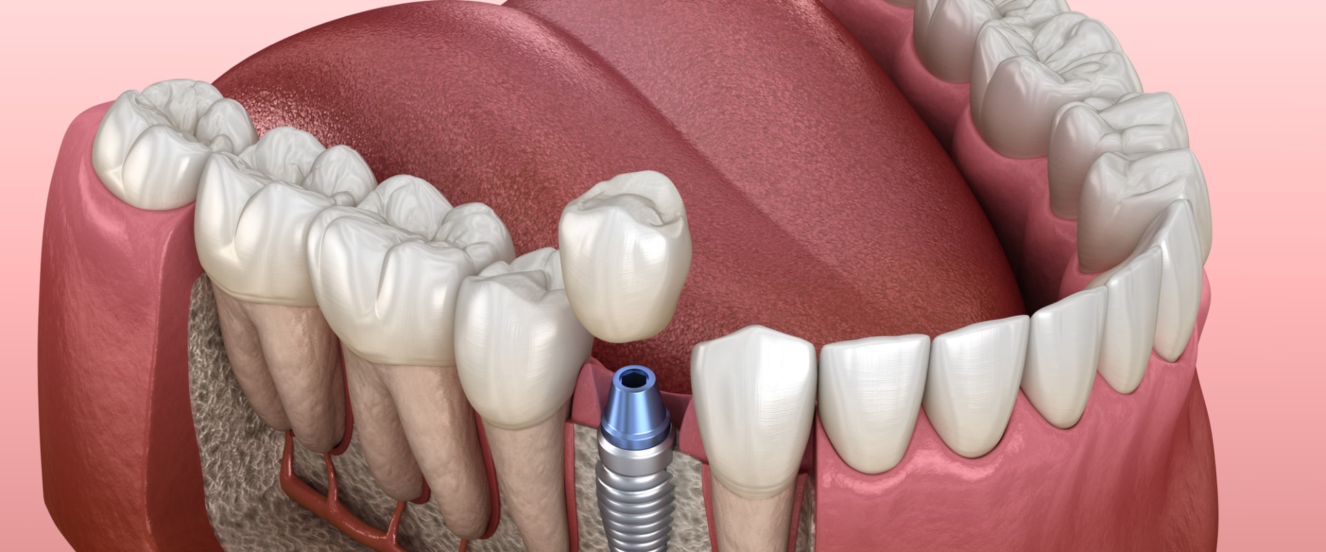 Are dental implants harmful?