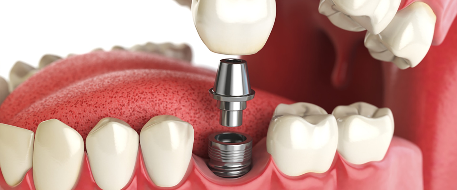 Are dental implants worth the money?