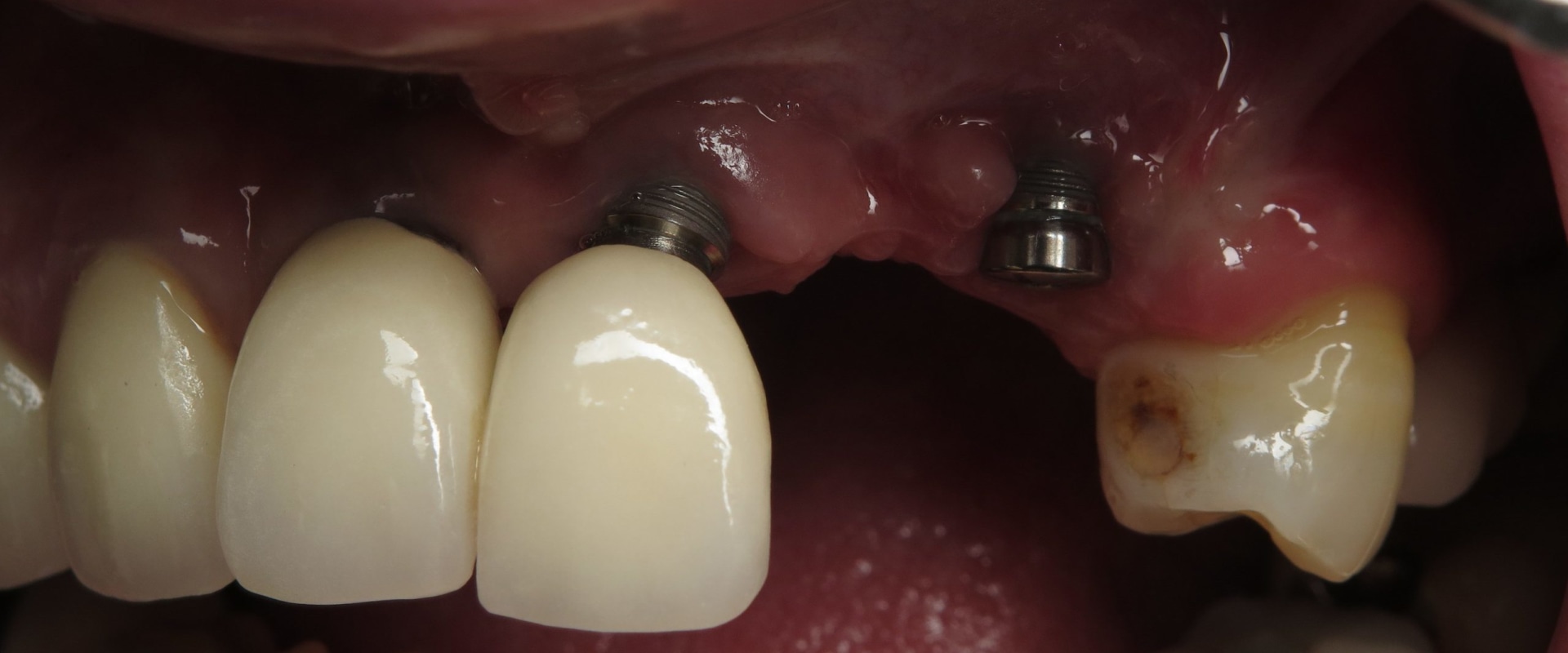 What is the failure rate of dental implants?