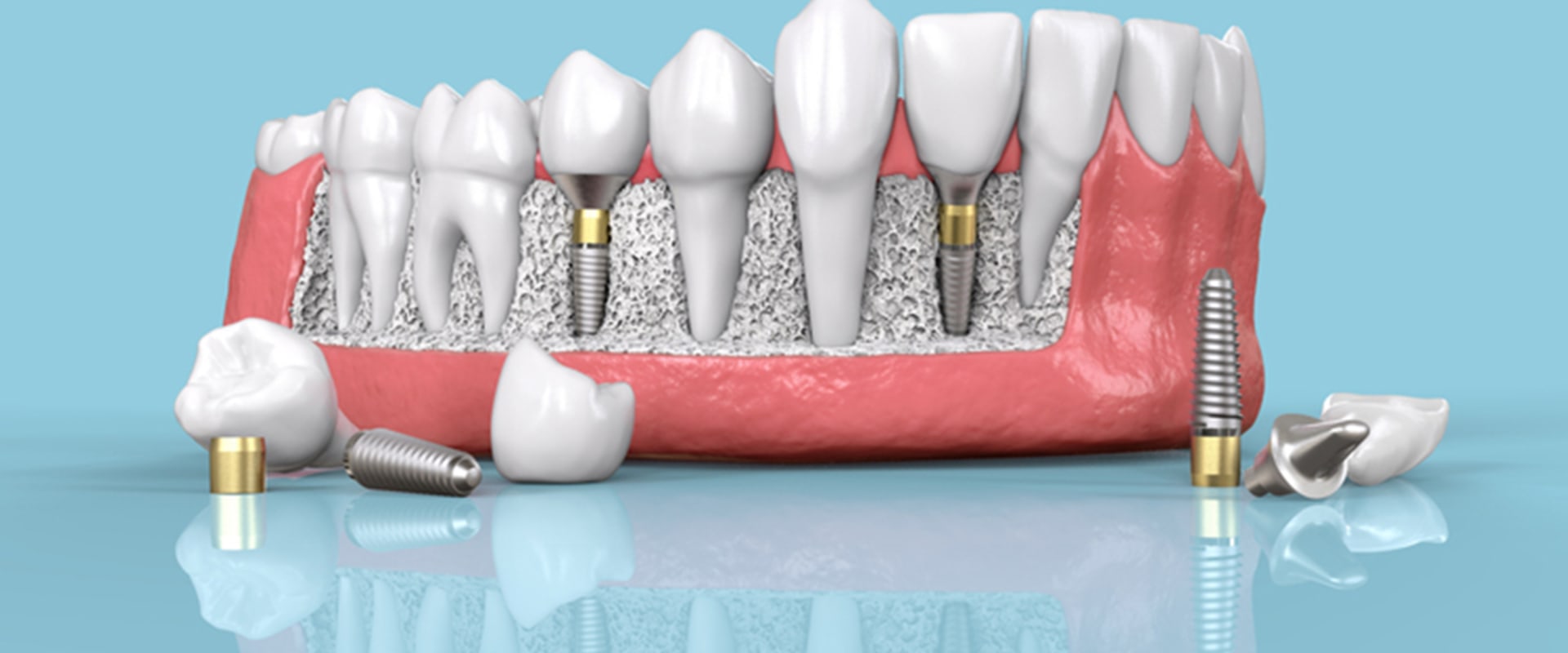 Do dental implants have an expiration date?