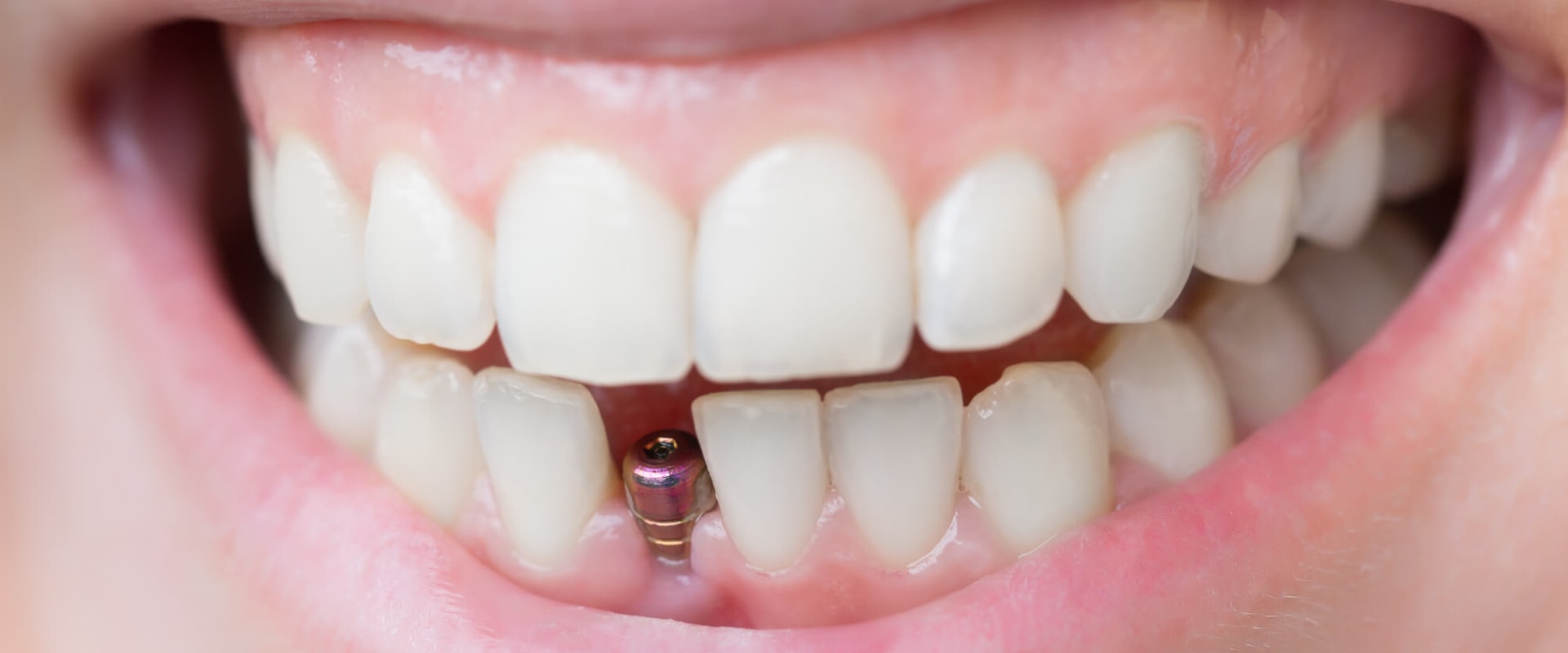 When is a dental implant needed?