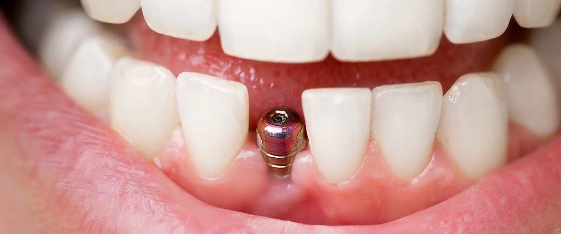 Can a dental implant be done in one day?