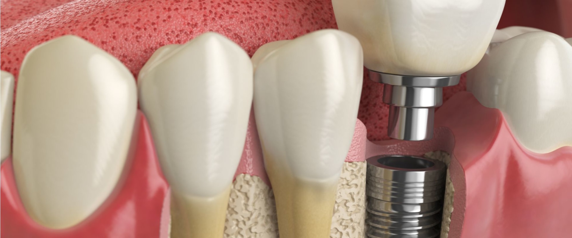 What is the code for dental implants?