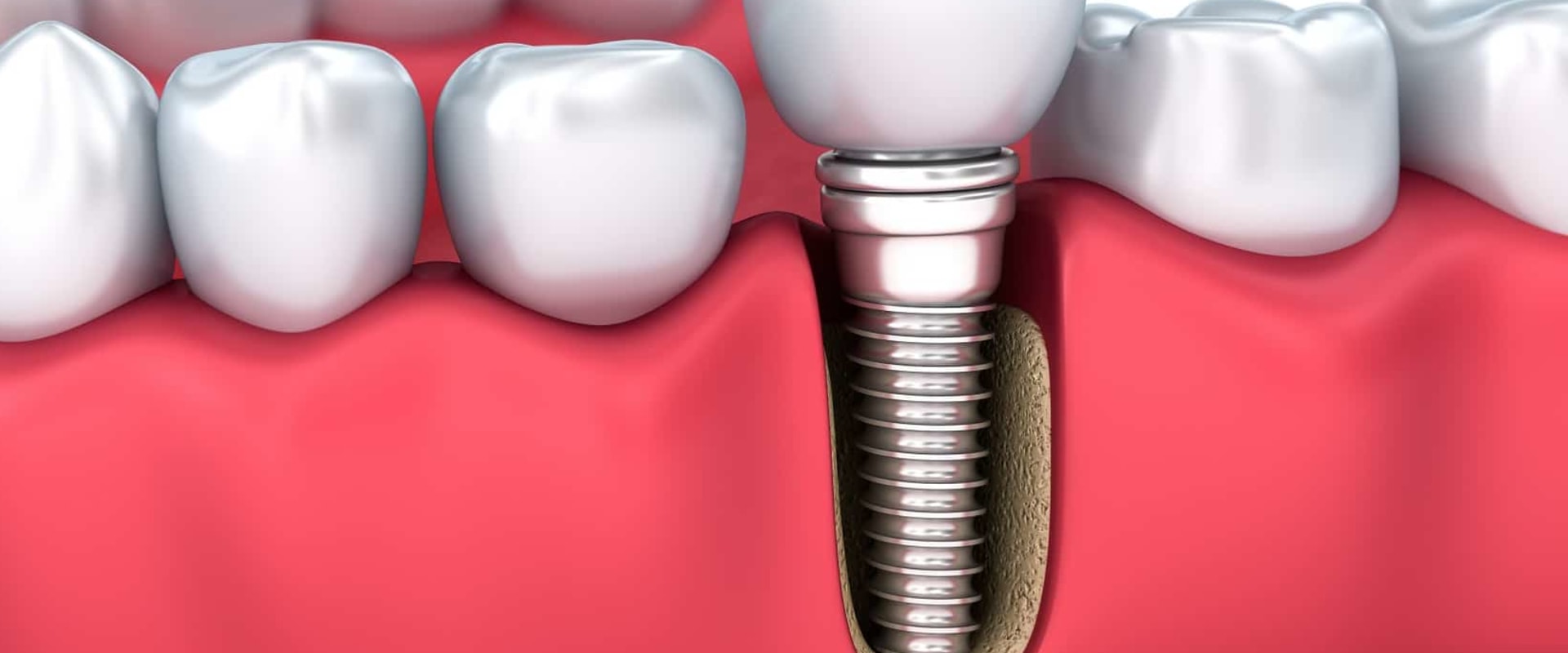 Are dental implants a bad idea?