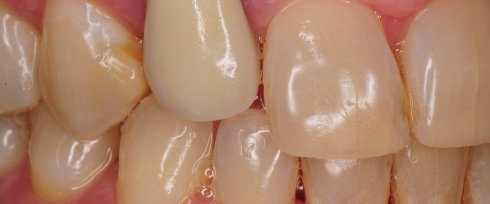 Can the dental implant be infected?