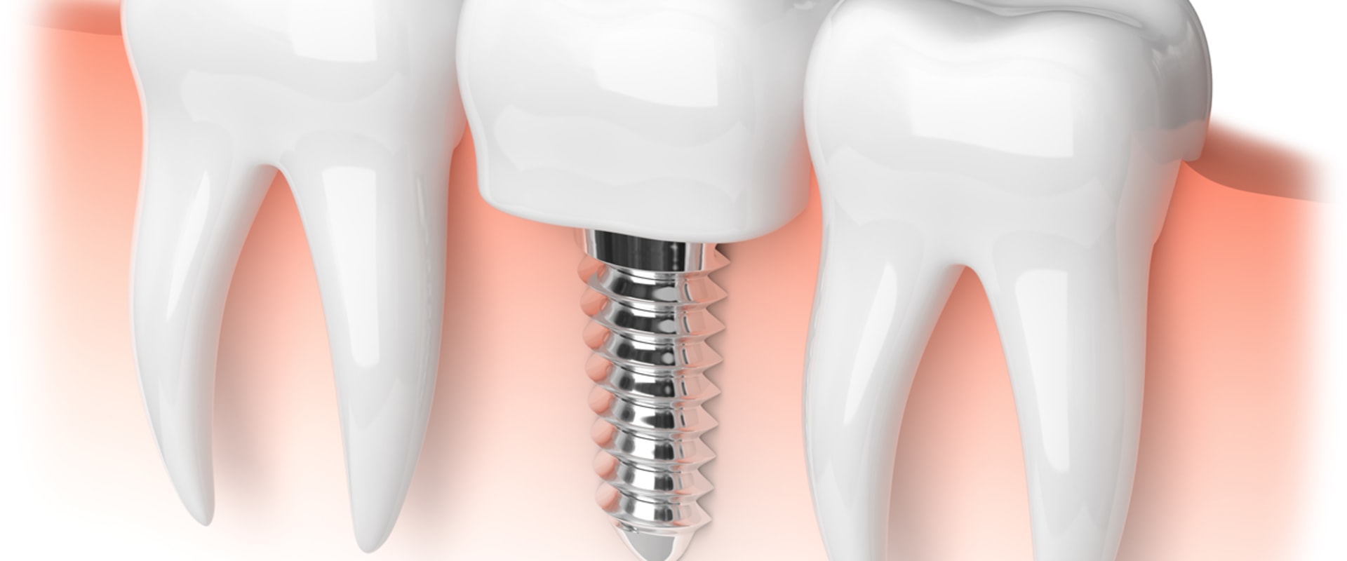Are some dental implants better than others?