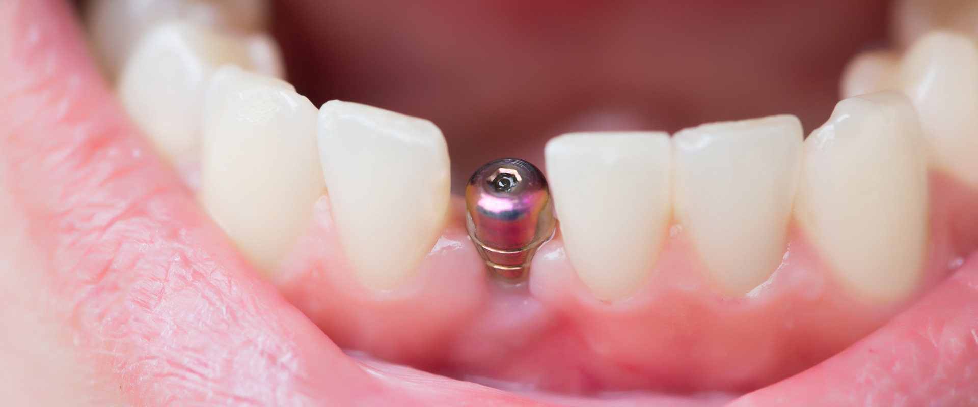 What is dental implant surgery?