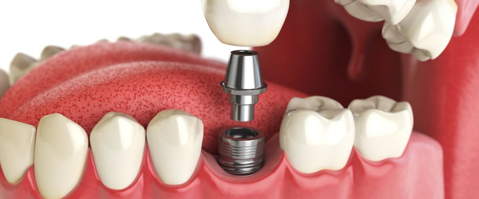 How much does the dental implant cost?