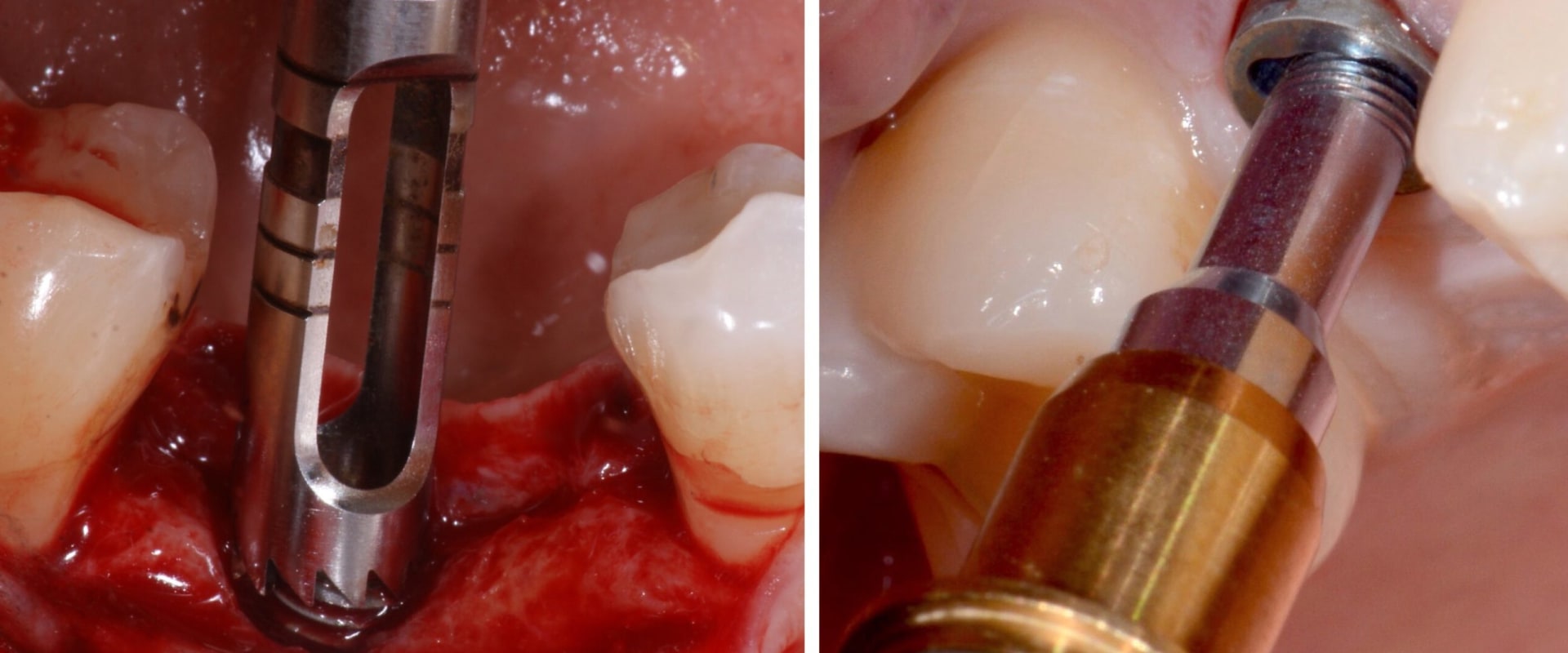 When to remove the dental implant?