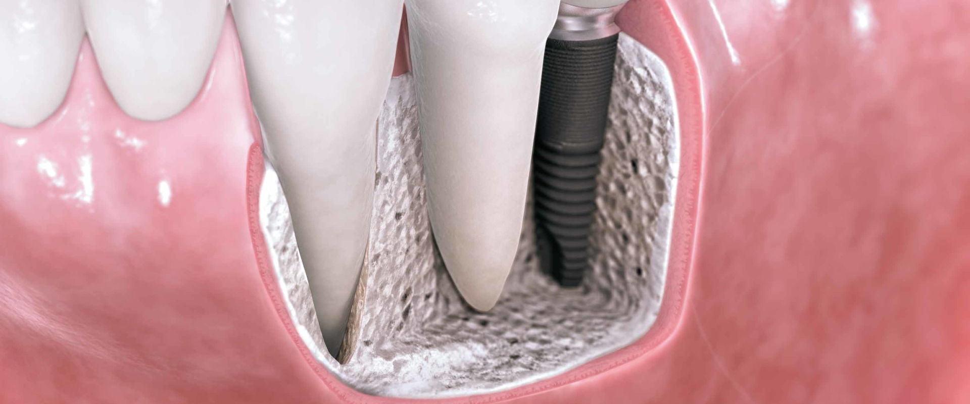 What does the dental implant look like?