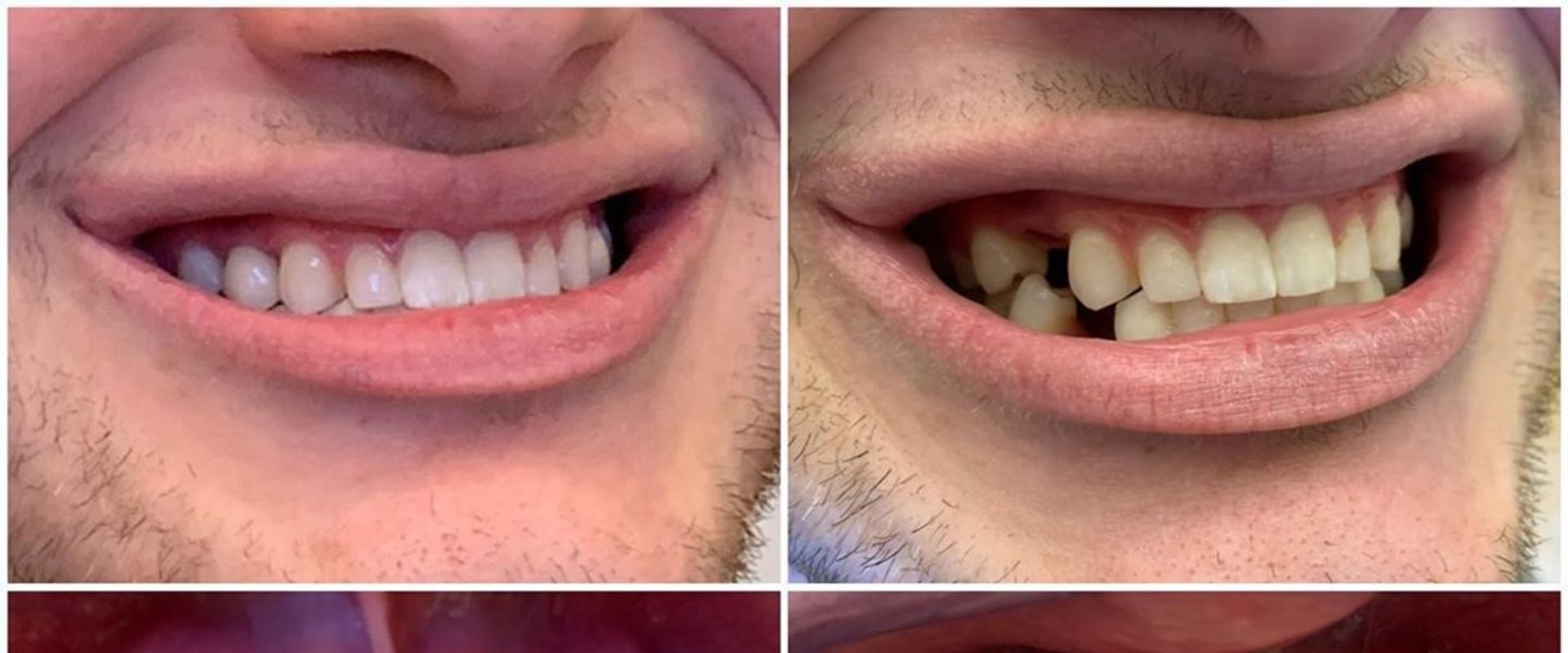 Can dental implants be done in one day?