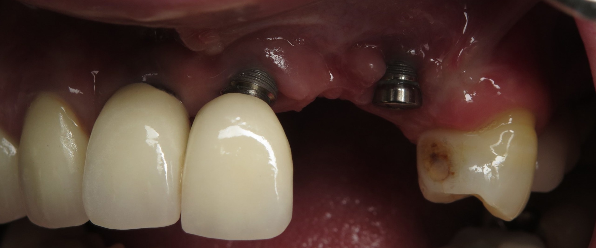 What happens when the dental implant fails?