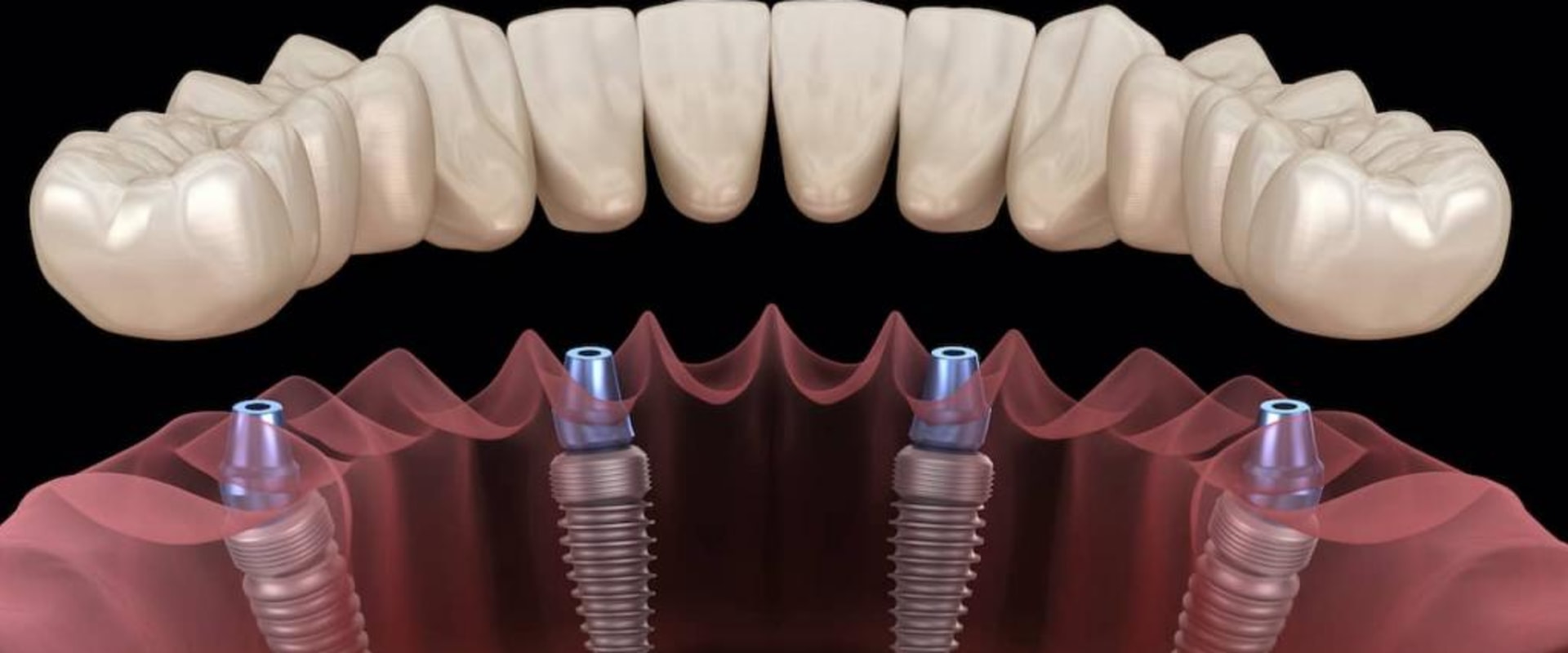 What type of dental implant is the best?