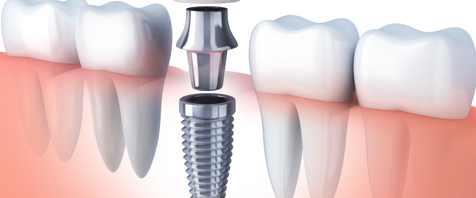 How much pain for dental implants?