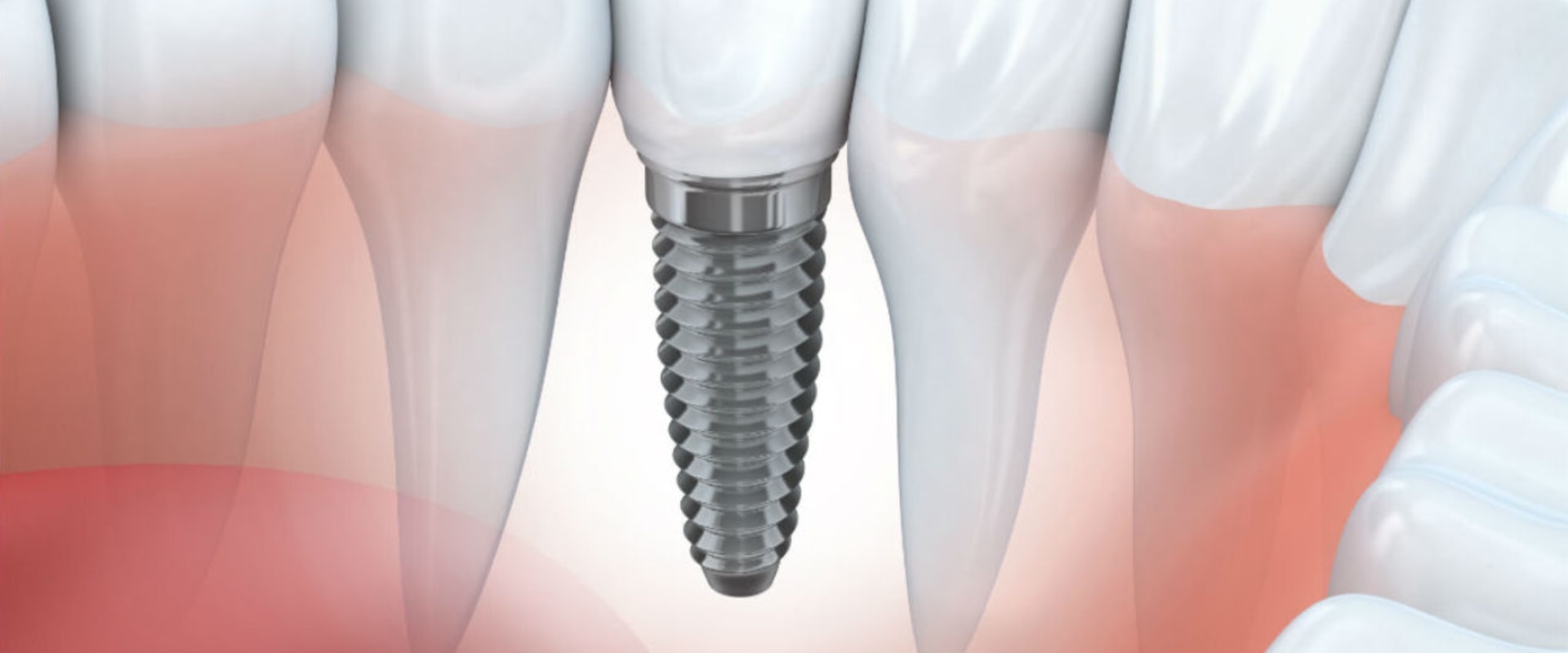 Definition of dental implant of whom?