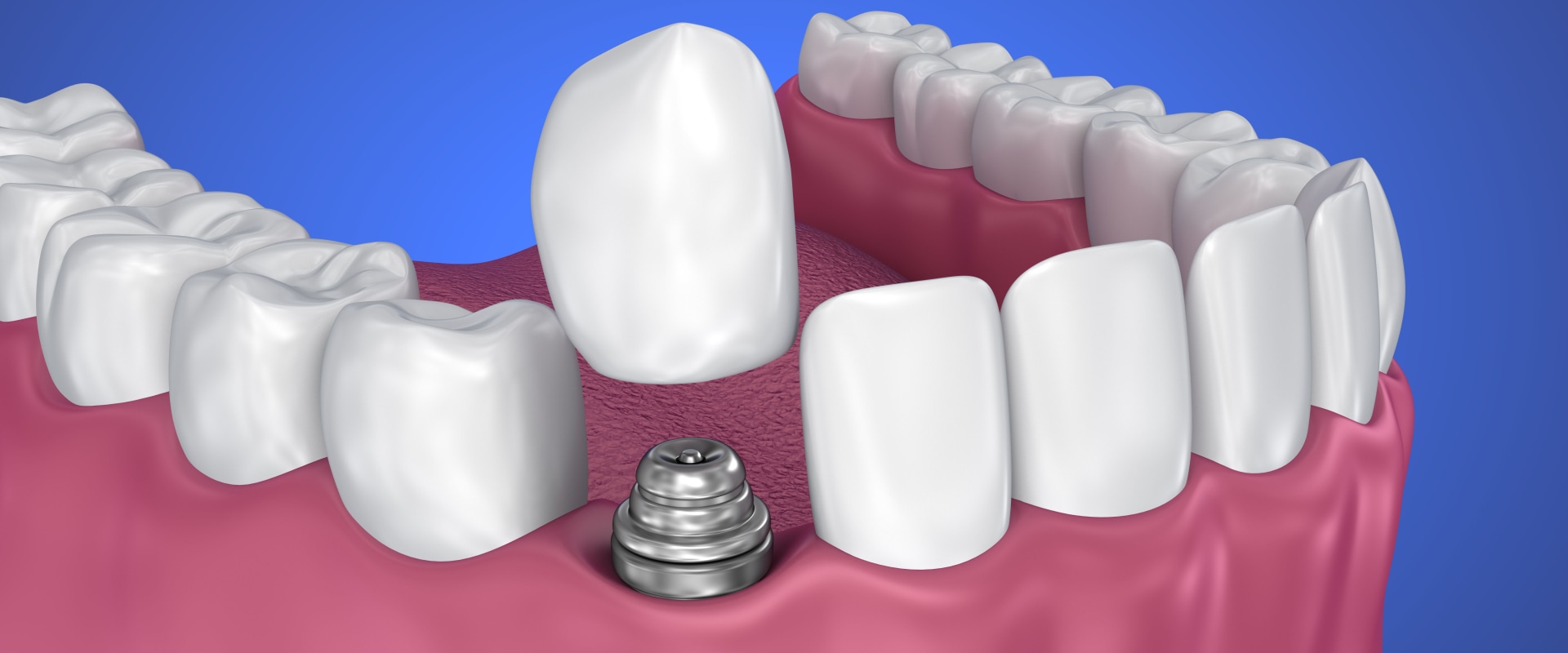 What causes dental implant failure?