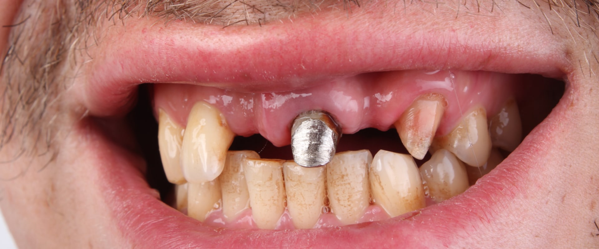 What are the long-term effects of dental implants?