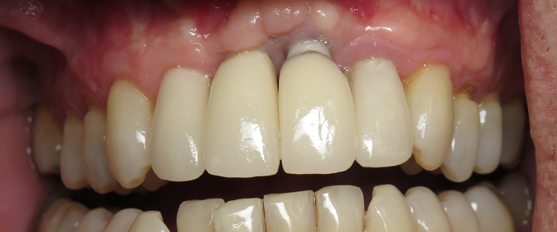 Why are dental implants a bad idea?
