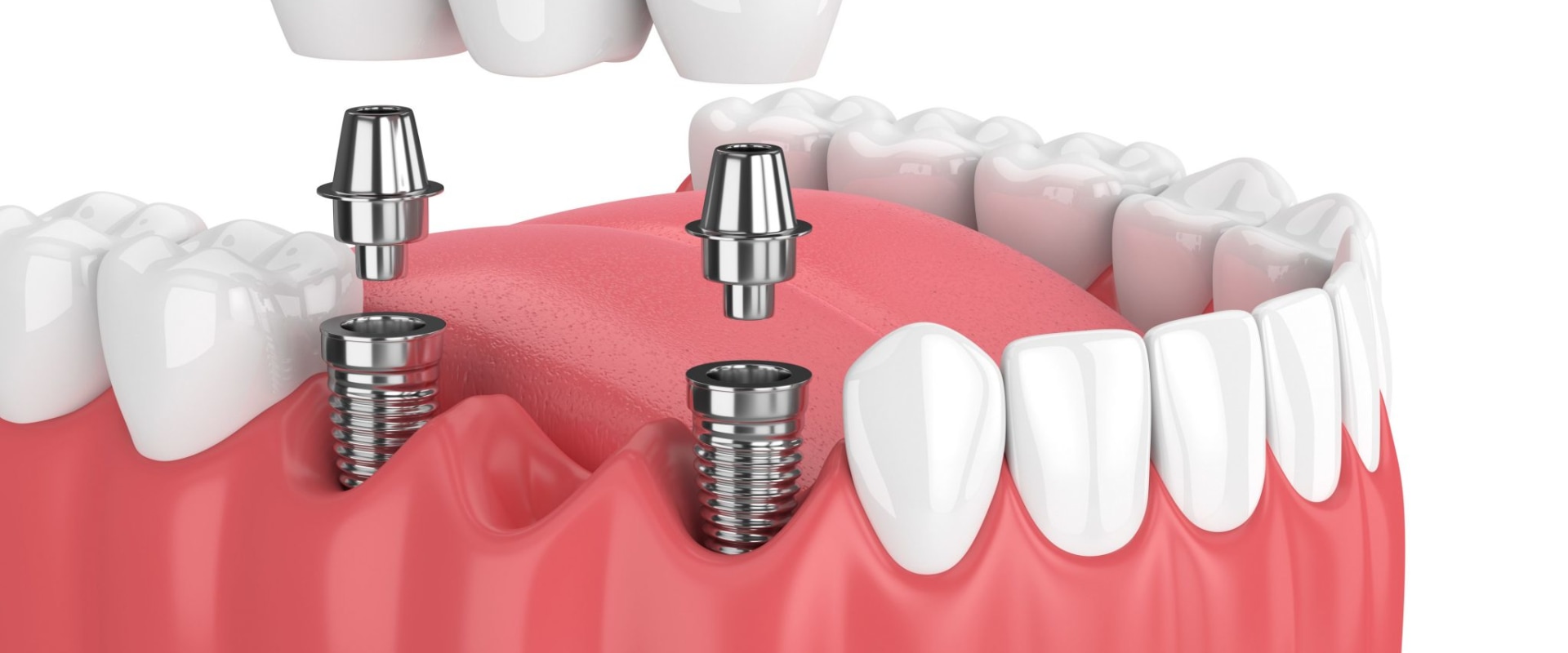 What dental implant is this?