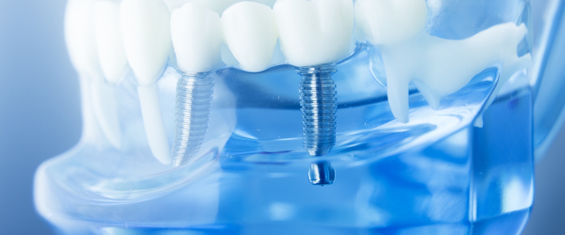 Who is not suitable for dental implants?
