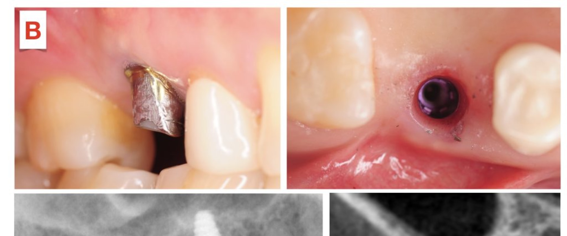 Why should a dental implant never be placed?
