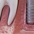 Can the dental implant cause a headache
