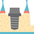 Do dental implants have serial numbers?