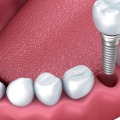 Are dental implants rejected?