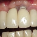 Do dental implants reduce life expectancy?