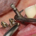Can the screws be removed from dental implants?