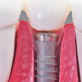How common is the rejection of dental implants?