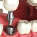 Is a dental implant worth it?