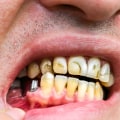Do dental implants cause health problems?