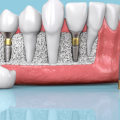 Do dental implants have an expiration date?