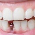 When is a dental implant needed?