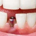 Can a dental implant be done in one day?