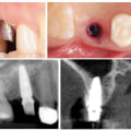 Why are dental implants bad?