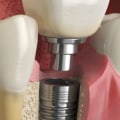 What is the code for dental implants?