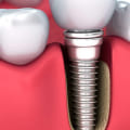 Are dental implants a bad idea?