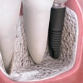 Can an implant be made for a tooth?
