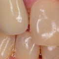 Can the dental implant be infected?
