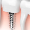 Are some dental implants better than others?