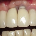 Can you say that dental implants are fake?