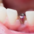 What is dental implant surgery?